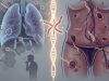 TUBERCULOSIS Y SÍFILIS: OTROS FRENTES DE ALARMA